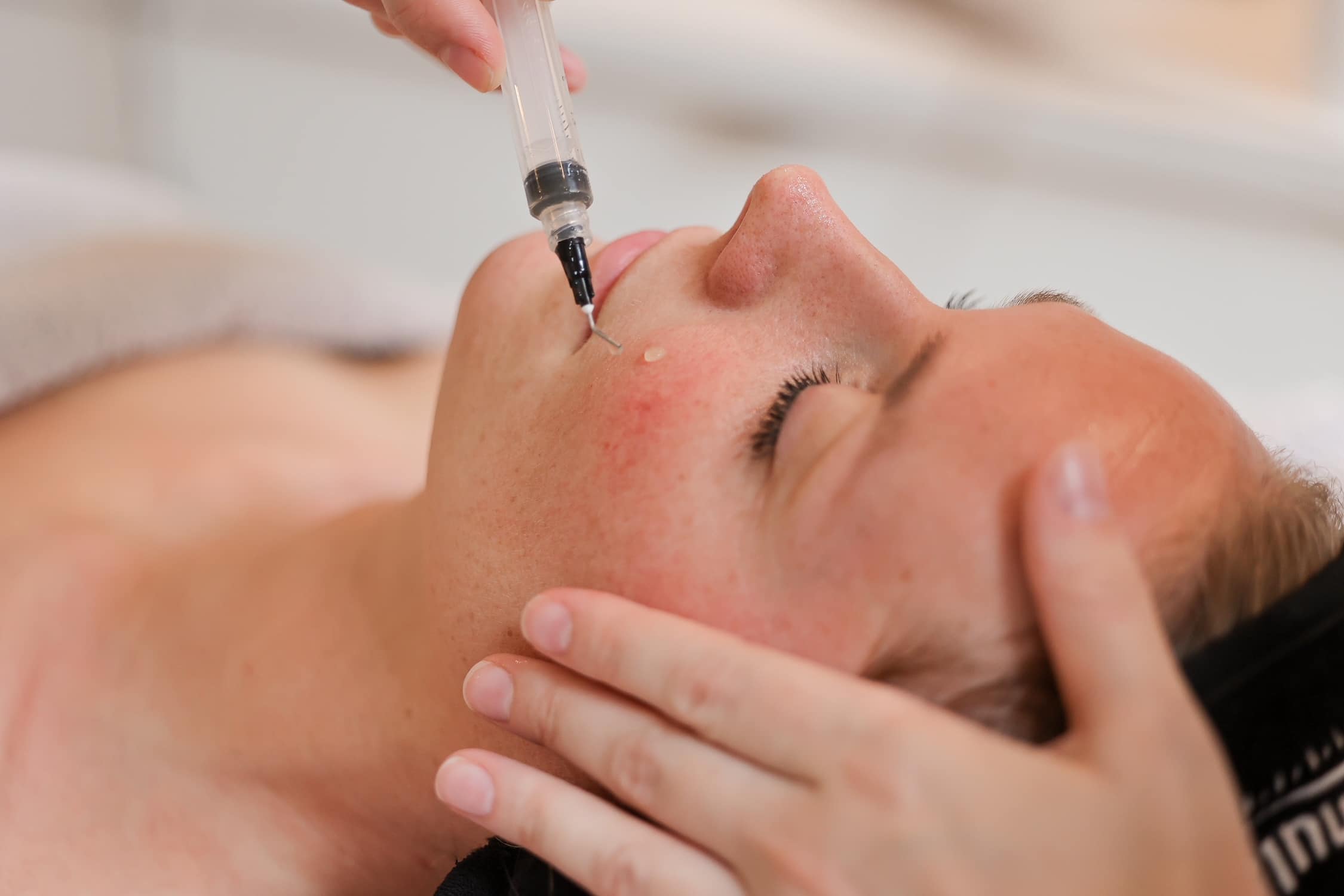 Microneedling PRX Huidboost behandeling