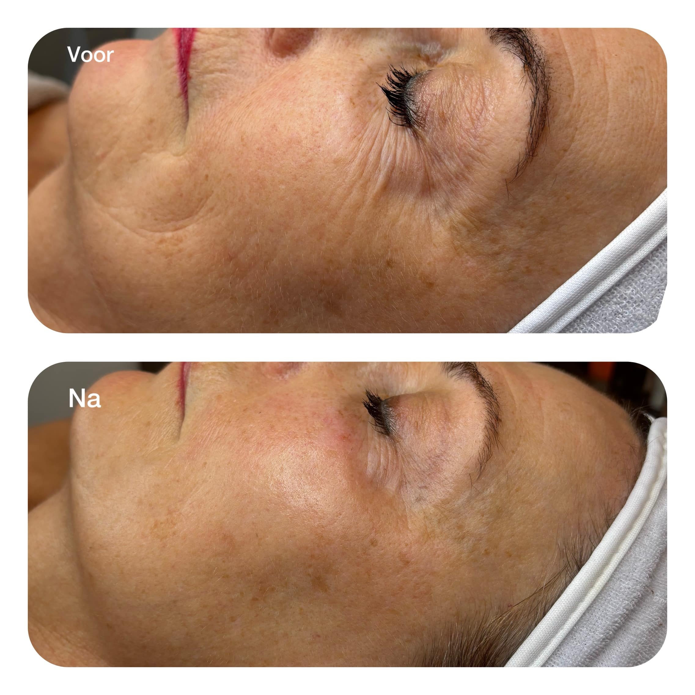 Microneedling PRX-Plus behandeling