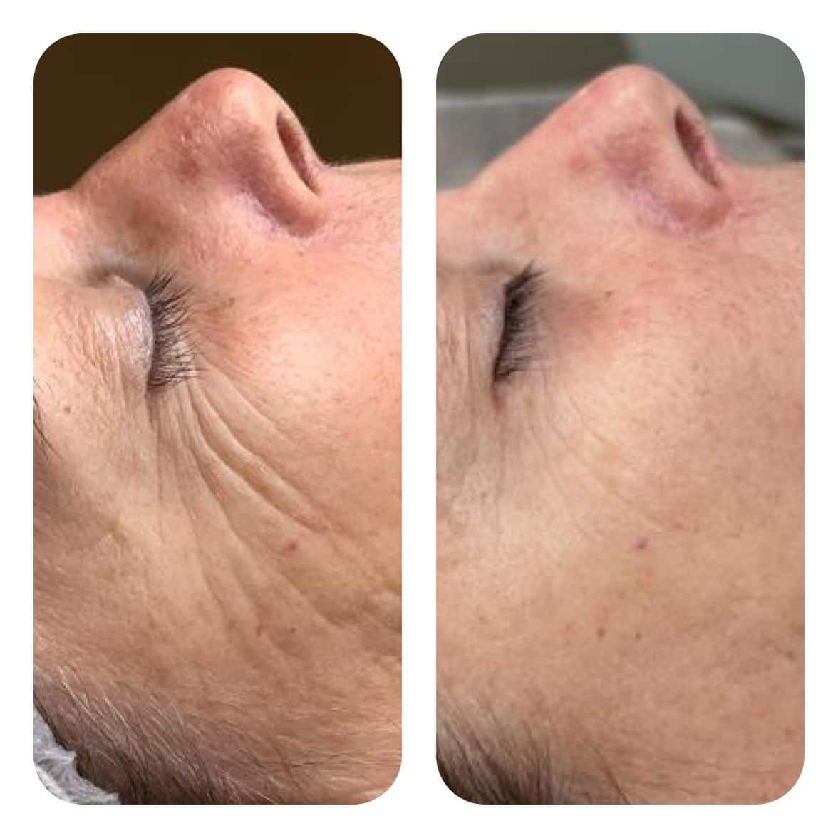 Resultaat Microneedling PRX Huidboost