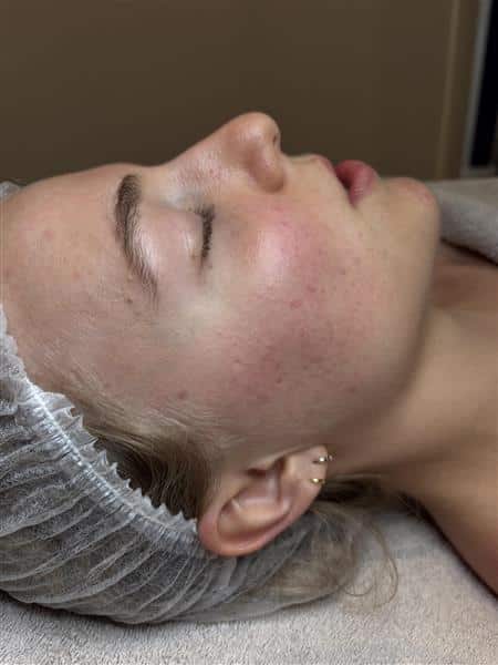 Acne na behandeling
