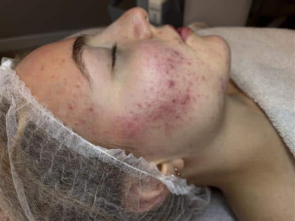 Acne voor behandeling