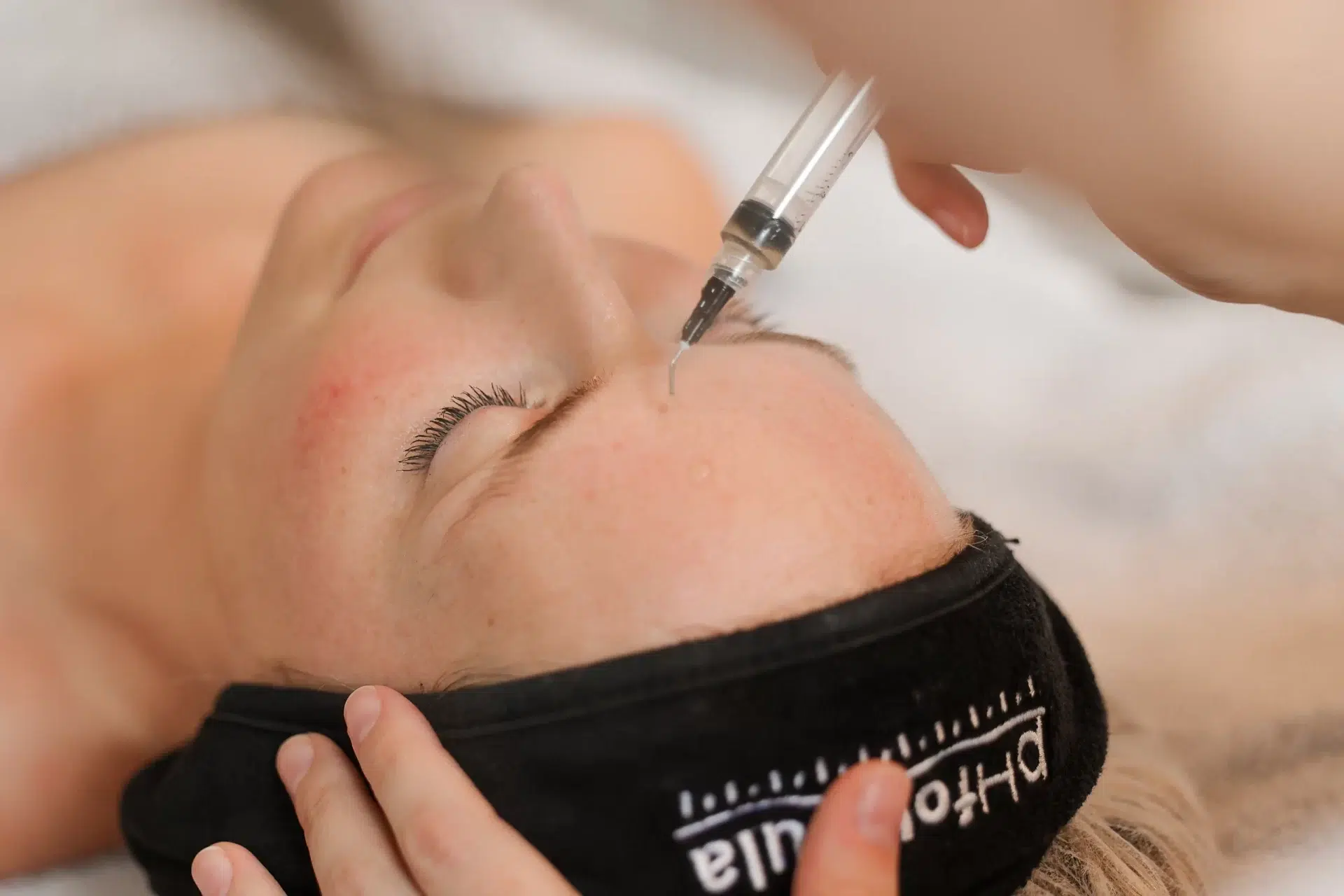 Microneedling met PRX-Plus peel bij Skinfluencers